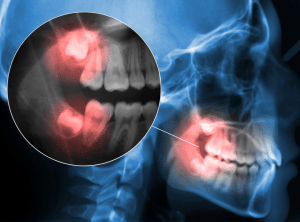 Wisdom Tooth Pain recommended removal